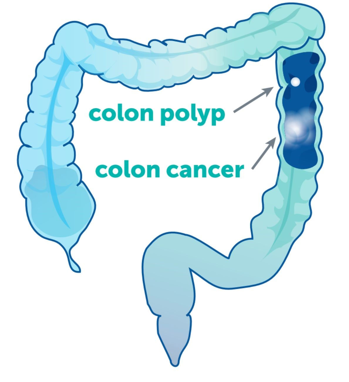 Colorectal cancer